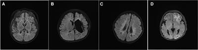 Crucial involvement of fast waves and Delta band in the brain network attributes of infantile epileptic spasms syndrome